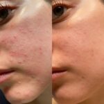 Cosrx Centella Blemish Cream - Image 3