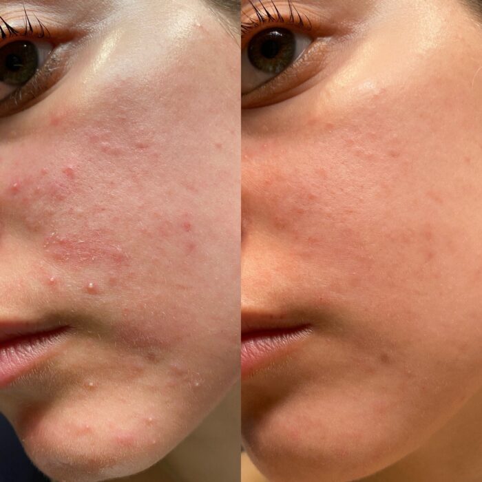 Cosrx Centella Blemish Cream - Image 3