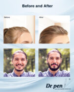 Dr.pen Bio needle Adjustable Derma Stamp,Professional microneedling stamp - Image 6