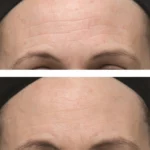 Dr. Dennis Gross Skincare Alpha Beta Ultra Gentle Daily Peel 5 Treatments - Image 2