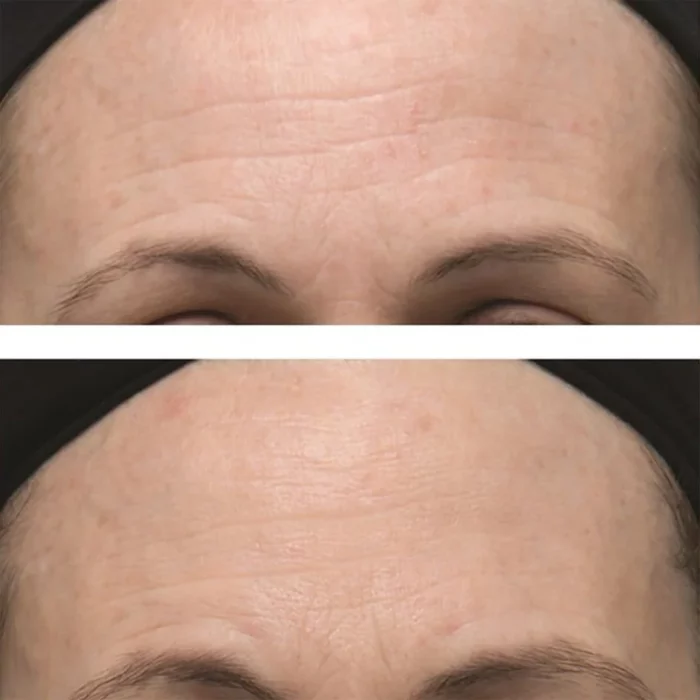 Dr. Dennis Gross Skincare Alpha Beta Ultra Gentle Daily Peel 5 Treatments - Image 2